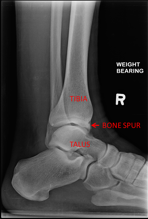 Ankle Pain from Bone Spurs? Surgery Can Help You!
