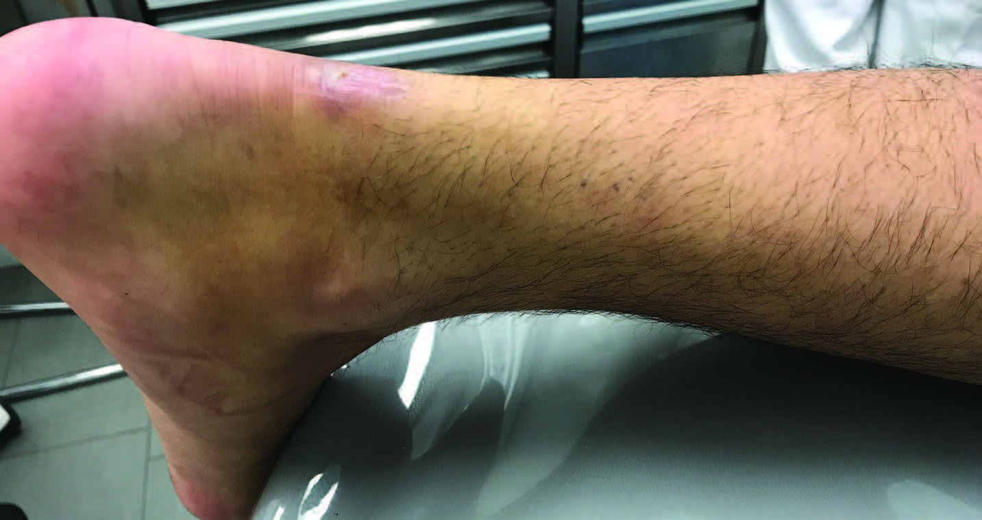 See achilles tendon rupture photos before and after surgery: Clearly visualizing the entire healing process.