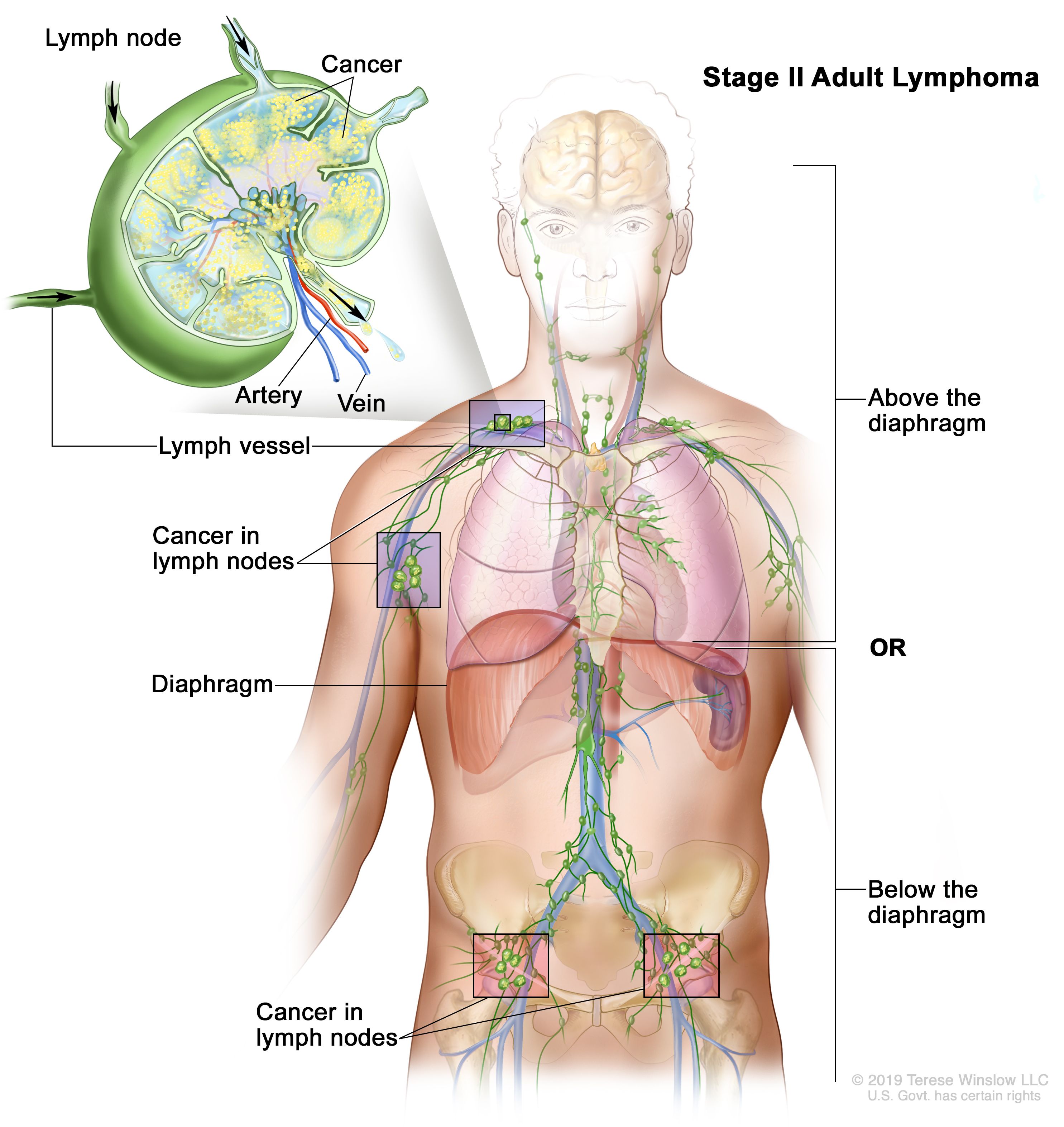 What exactly is lymphoma in Spanish? Get easy definitions and important terms for Spanish speakers now.