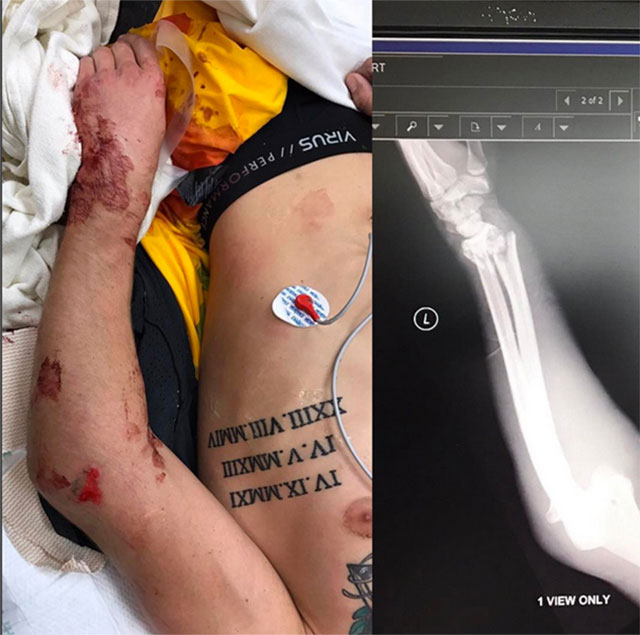 Ken Roczen arm injury full story (Timeline and key facts revealed)